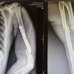 Harry suffers multiple broken bone injuries in accident at Estoril